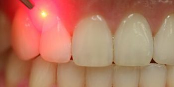 درمان با لیزر در دندانپزشکی چیست؟